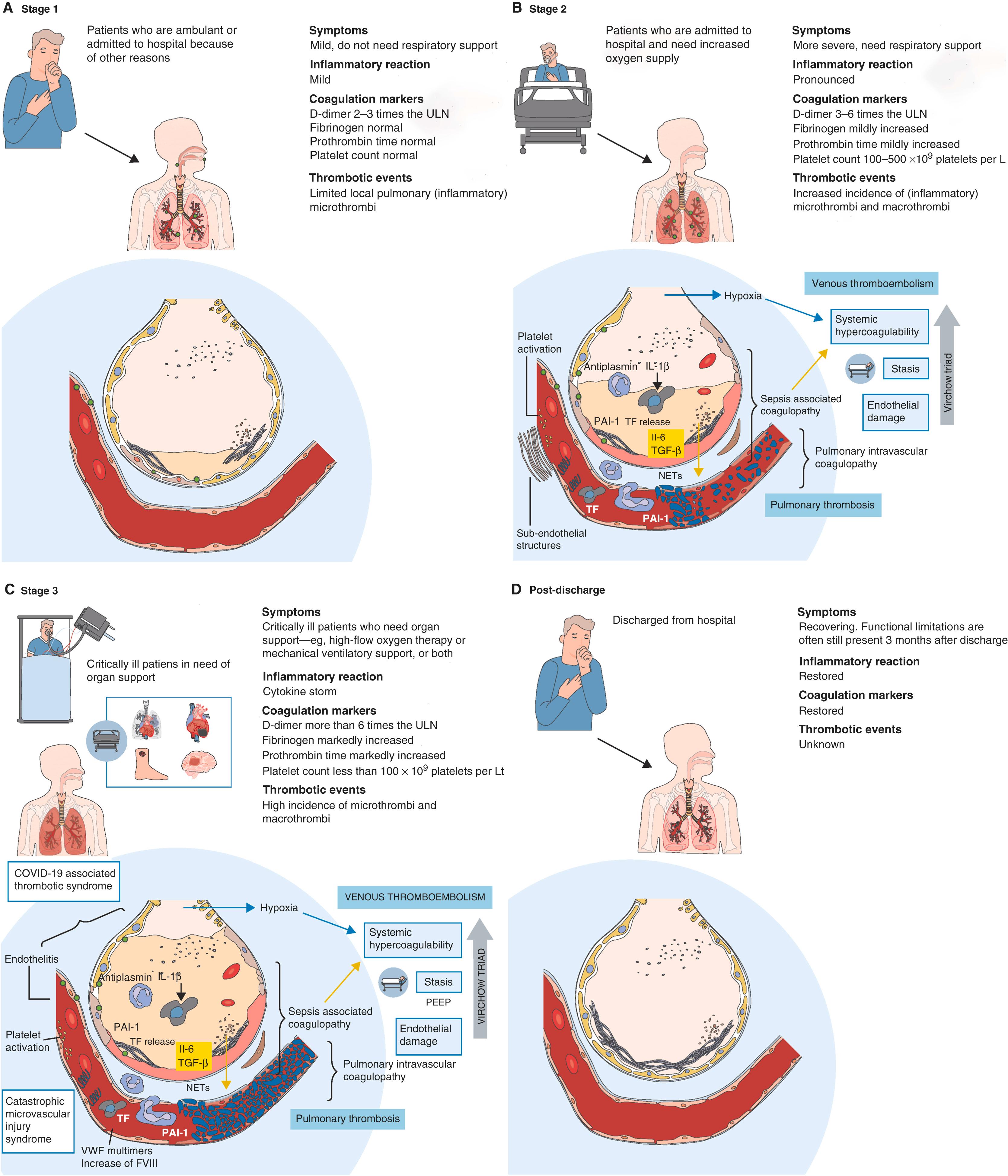 Figure 4.11, Clinical and pathophysiological staging in COVID-19. (A) A good immune response will adequately control viral replication, resulting in mild symptoms in around 80% of infections. (B) Poorly controlled viral replication leads to apoptosis of pneumocytes and endothelial cells, which will activate platelets, induce coagulation factors such as TF, and release VWF multimers, and will lead to increased chemotaxis, cytokine and chemokine production, NET formation, and activation of the plasma kinin–kallikrein and complement system. Hypoxia contributes to the hypercoagulable state by increased expression of TF and PAI-1, decreased TF pathway inhibitor and protein S, and an increased inflammatory response and platelet activation. Further destruction of pneumocytes, pulmonary microangiopathy, and microthrombi causes more severe symptoms and need for additional oxygen supply. (C) The so-called cytokine storm fuels proinflammatory and procoagulatory processes further, resulting in systemic endotheliitis and capillary leakage, cellular dysfunction, organ dysfunction, and overt activation of the coagulation cascade, and leads to the need for organ support and a high prevalence of microthrombi and macrothrombi. (D) The timeframe of resolution of local inflammation and coagulation after discharge are still unknown. IL , interleukin; NETs , neutrophil extracellular traps; PAI-1 , plasminogen activator inhibitor-1; PEEP , positive end-exploratory pressure; TF , tissue factor; TGF-β , transforming growth factor beta; ULN , upper limit of normal; VWF , von Willebrand factor.