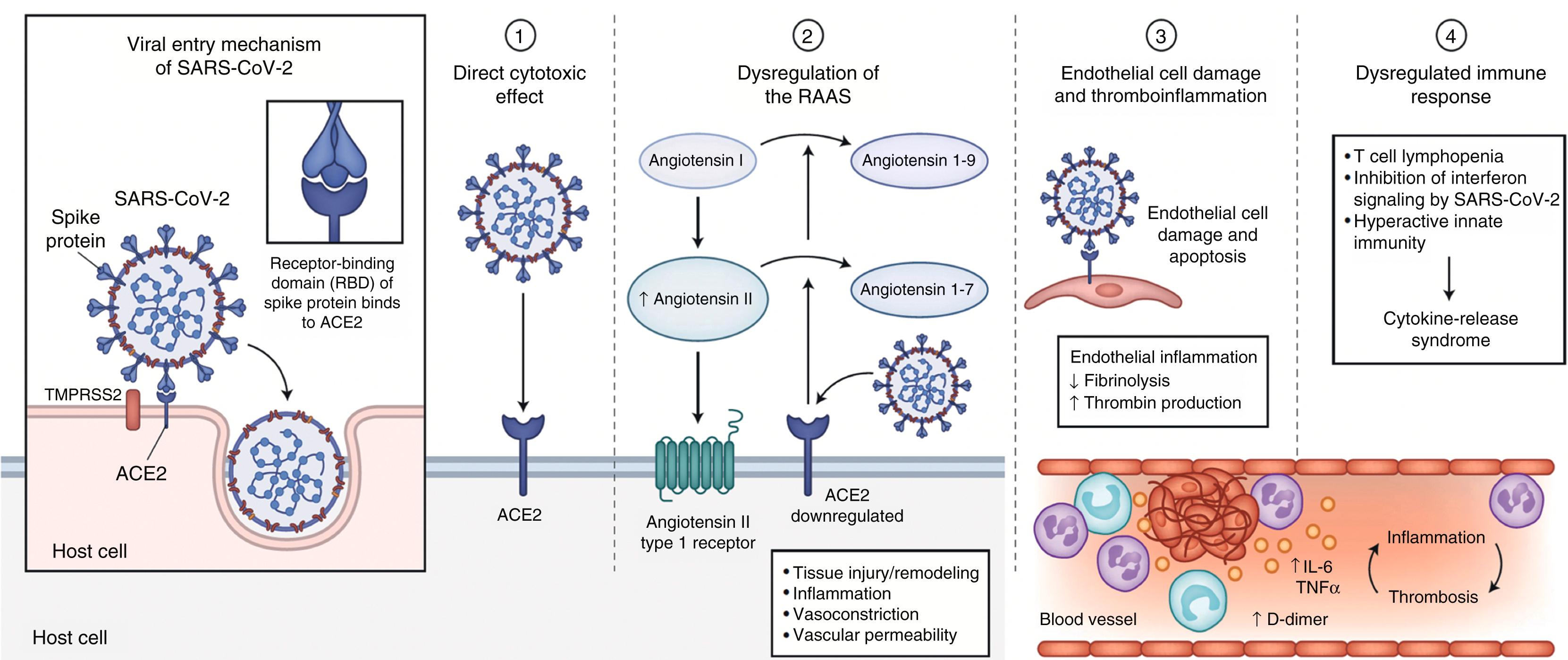 Figure 4.3, Pathophysiology of COVID-19. SARS-CoV-2 enters host cells through interaction of its spike protein with the entry receptor angiotensin-converting enzyme 2 (ACE2) in the presence of transmembrane serine protease 2 (TMPRSS2) (far left). Proposed mechanisms for COVID-19 caused by infection with SARS-CoV-2 include (1) direct virus-mediated cell damage; (2) dysregulation of the renin–angiotensin–aldosterone system (RAAS) as a consequence of downregulation of ACE2 related to viral entry, which leads to decreased cleavage of angiotensin I and angiotensin II; (3) endothelial cell damage and thromboinflammation; and (4) dysregulation of the immune response and hyperinflammation caused by inhibition of interferon signaling by the virus, T cell lymphodepletion, and the production of proinflammatory cytokines, particularly interleukin-6 (IL-6) and tissue necrosis factor alpha (TNFα) .