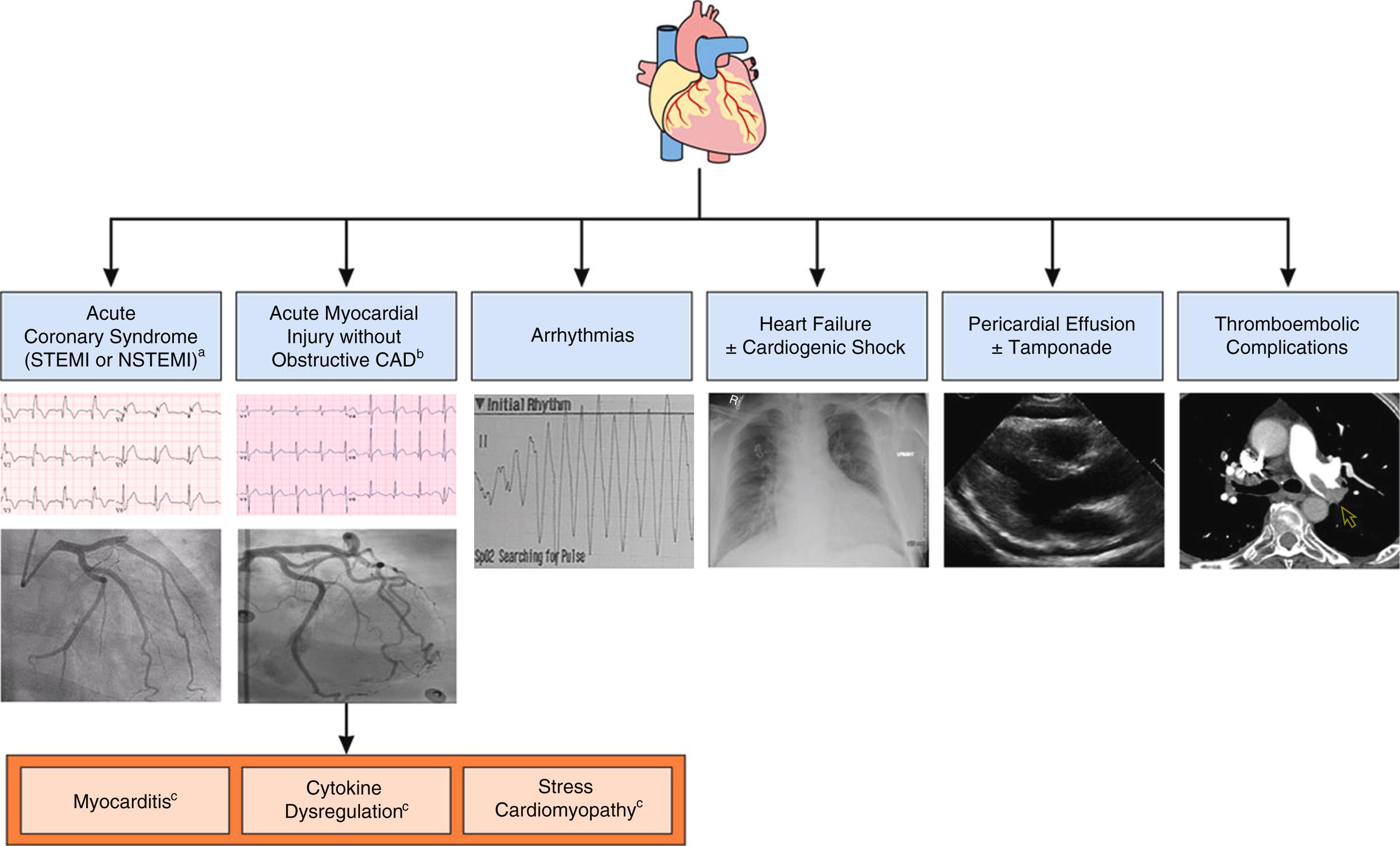 Figure 4.6, Spectrum of the acute coronavirus disease 2019 (COVID-19) cardiovascular syndrome (ACovCS). The spectrum of ACovCS encompasses a variety of cardiovascular syndromes described for patients presenting with COVID-19. Reports of pericardial effusions and cardiac tamponade in patients with COVID-19 have been published. Although the prevalence of pericardial effusion in ACovCS remains uncertain, significant effusions do not appear to be common. Clinical images are representative of the proposed ACovCS disease spectrum, and several, but not all, images are from patients with ACovCS.