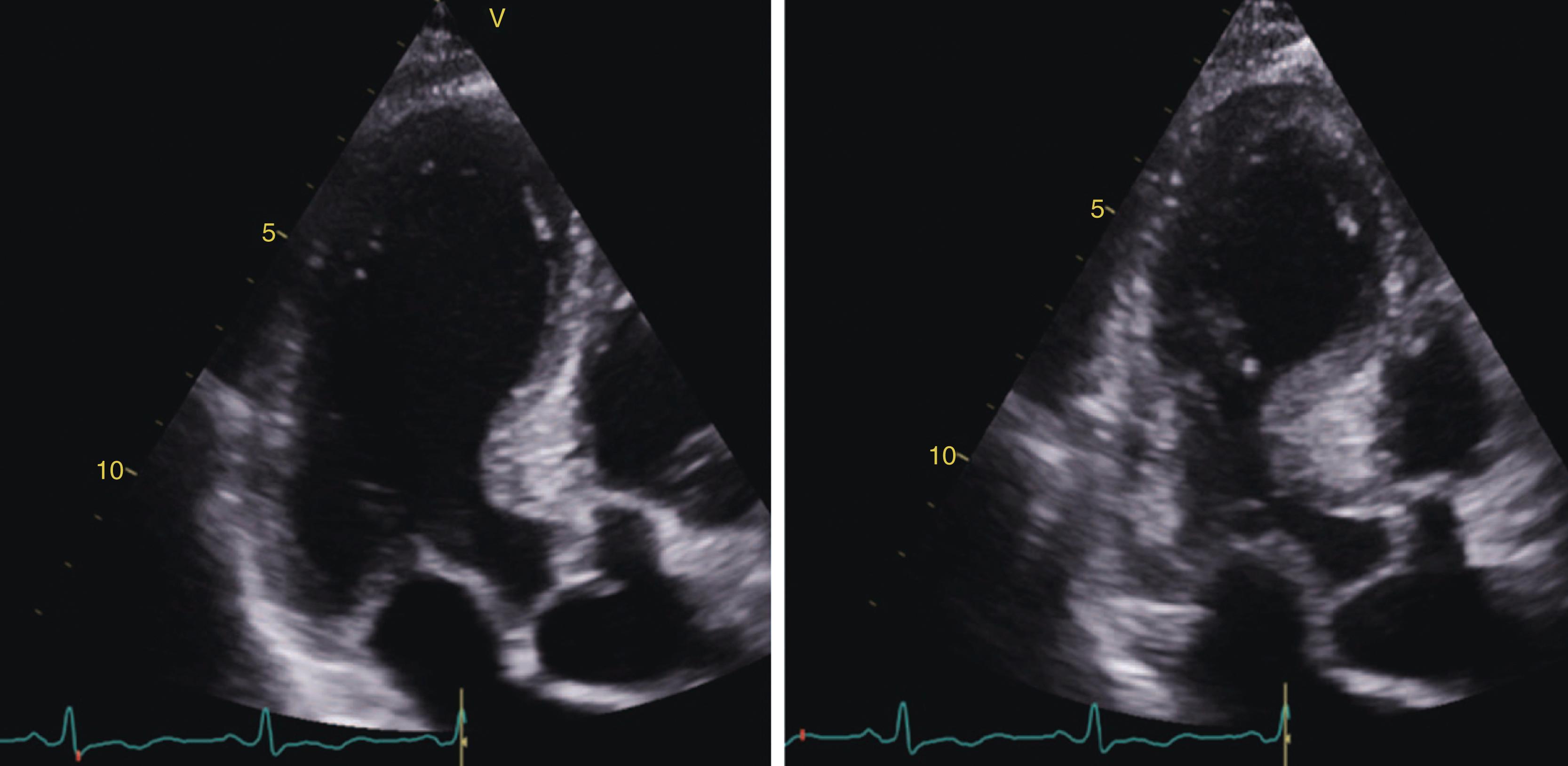 Figure 4.7, Transthoracic echocardiography images of a coronavirus disease 2019 patient with Takotsubo cardiomyopathy. Apical long-axis views. End-diastolic frame (left) and end-systolic frame (right) showing typical obstruction of the basal part of the heart and apical ballooning.