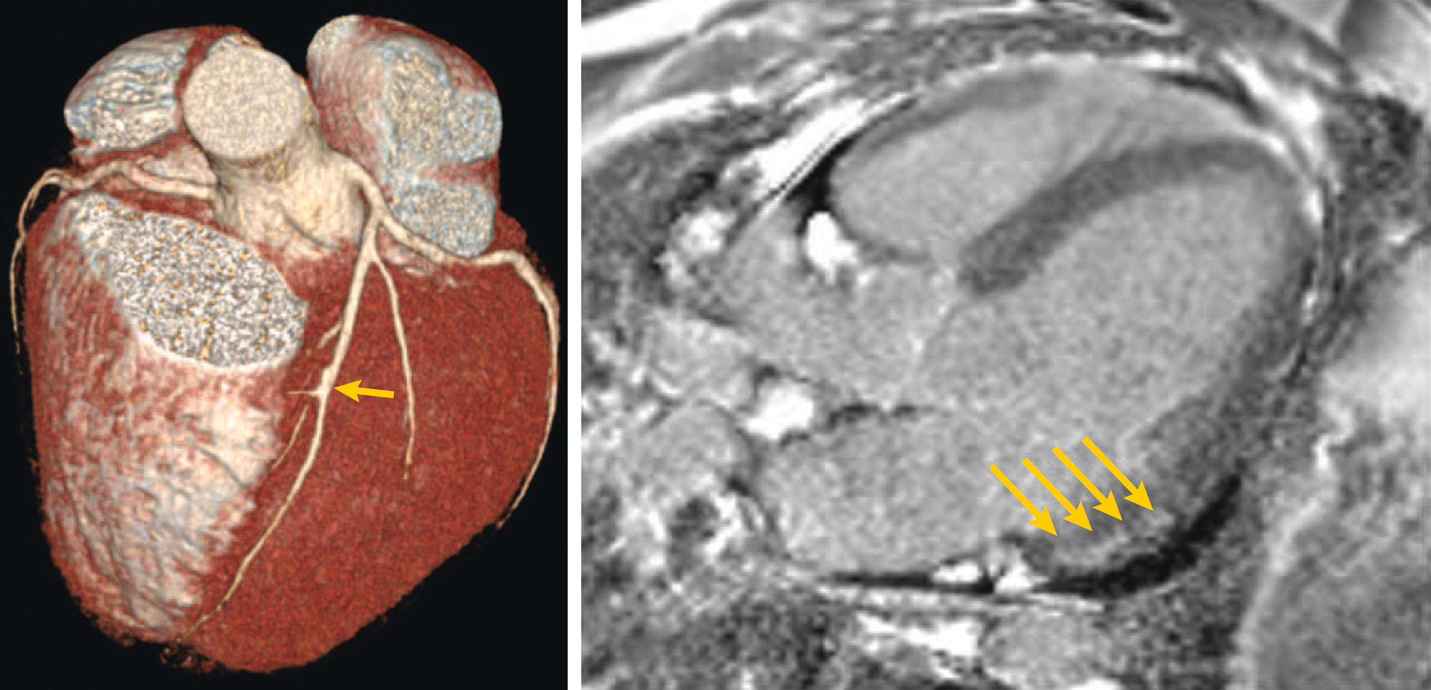 Figure 4.8, Cardiac computed tomography (left) and magnetic resonance (right) images of a coronavirus disease 2019 patient with chest pain and elevated cardiac troponins and left ventricular ejection fraction 44%. Cardiac CT shows open coronary artery, only a minor calcified lesion in mid-LAD (arrow) . Cardiac MR shows late gadolinium enhancement (arrows) in the left ventricular inferolateral wall, mid-myocardium/subepicardial, suggesting subacute perimyocarditis. CT , computed tomography; LAD , left anterior descending artery; MR , magnetic resonance.