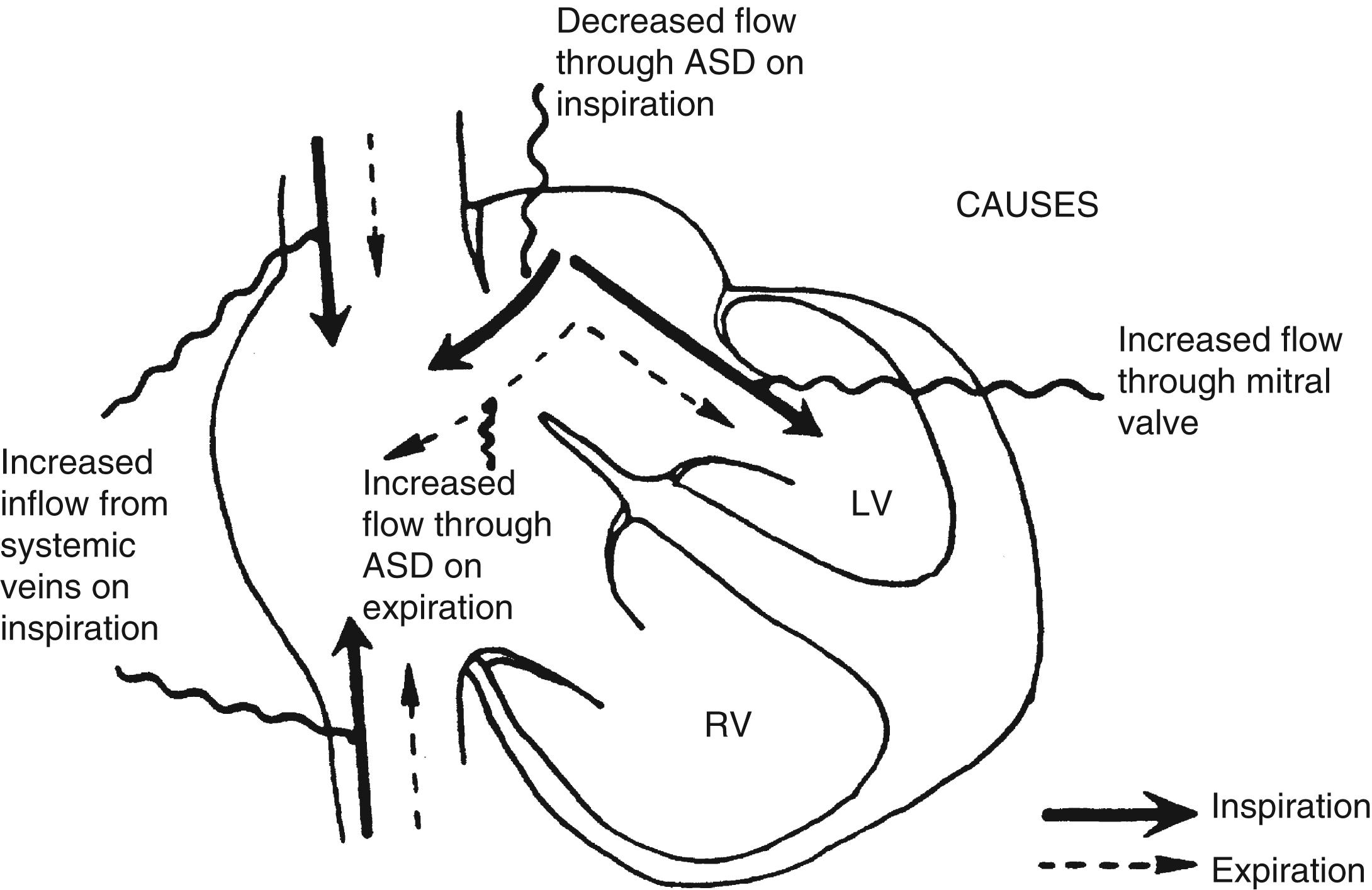 Fig. 10.13, The increased inflow into the right atrium on inspiration (vertical solid arrows) causes a decreased flow through the atrial septal defect (ASD) and thus increased flow through the mitral valve.