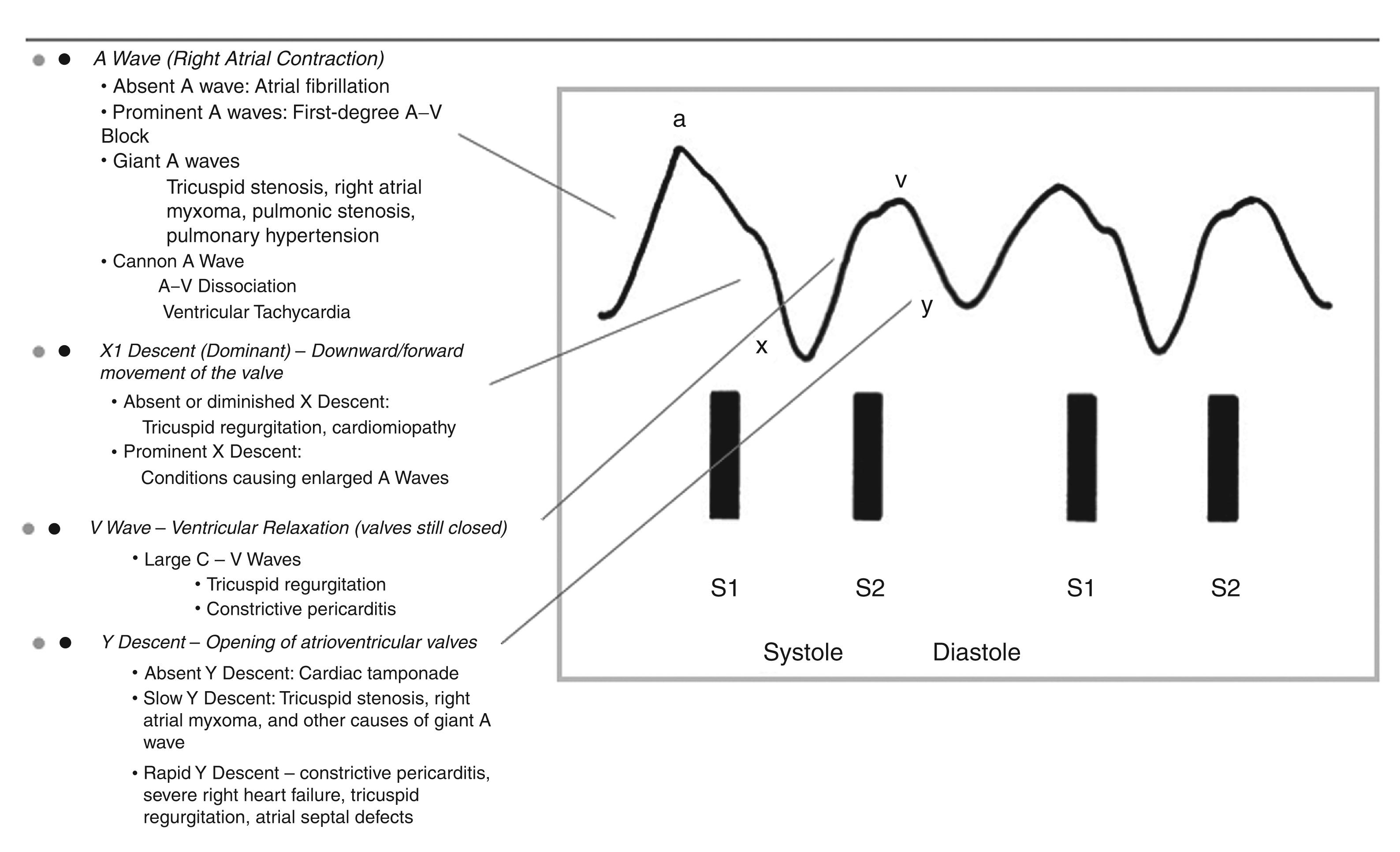 Fig. 10.8, Jugular venous pulsation: Normal and disease patterns.