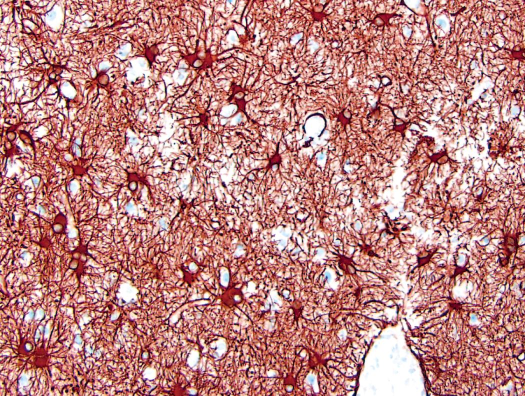 Figure 28.1, Reactive astrocytes. Immunohistochemical staining for glial fibrillary acidic protein (brown) highlights the stellate astrocytic processes from which the cell's name is derived.