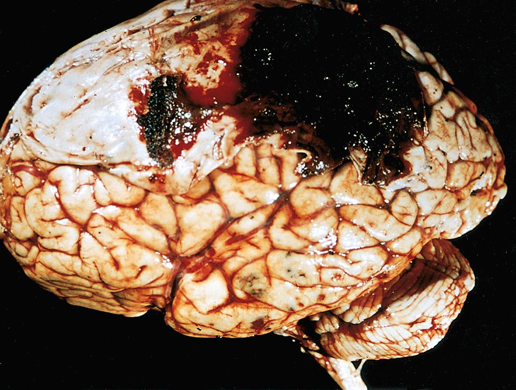 Figure 28.11, Epidural hematoma covering a portion of the dura. Also present are multiple small contusions in the temporal lobe.