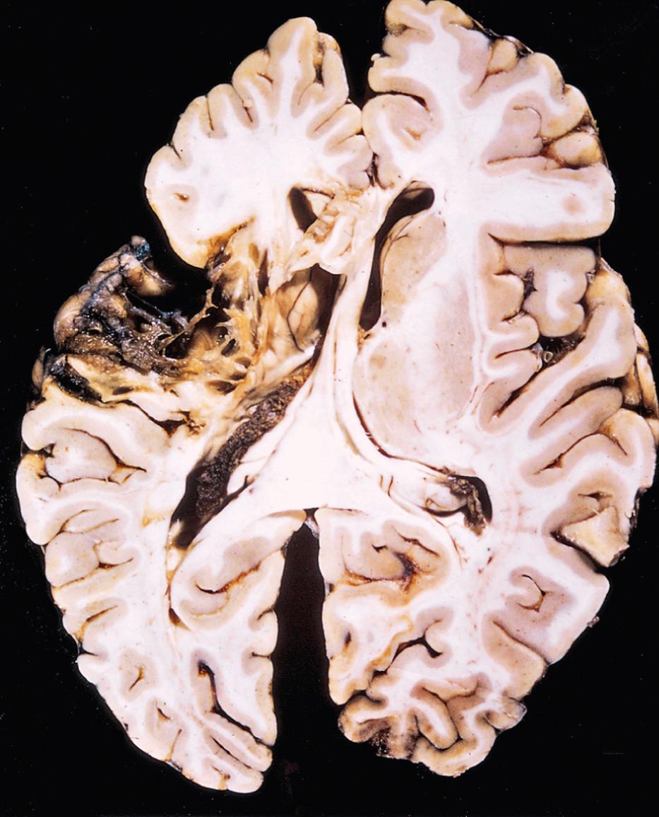 Figure 28.14, Old cystic infarct showing cavitation from loss of brain parenchyma.
