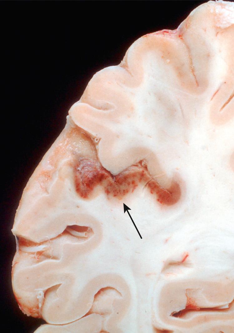 Figure 28.17, Classic watershed infarct with secondary hemorrhagic transformation (arrow); boundary between anterior and middle cerebral artery circulations.