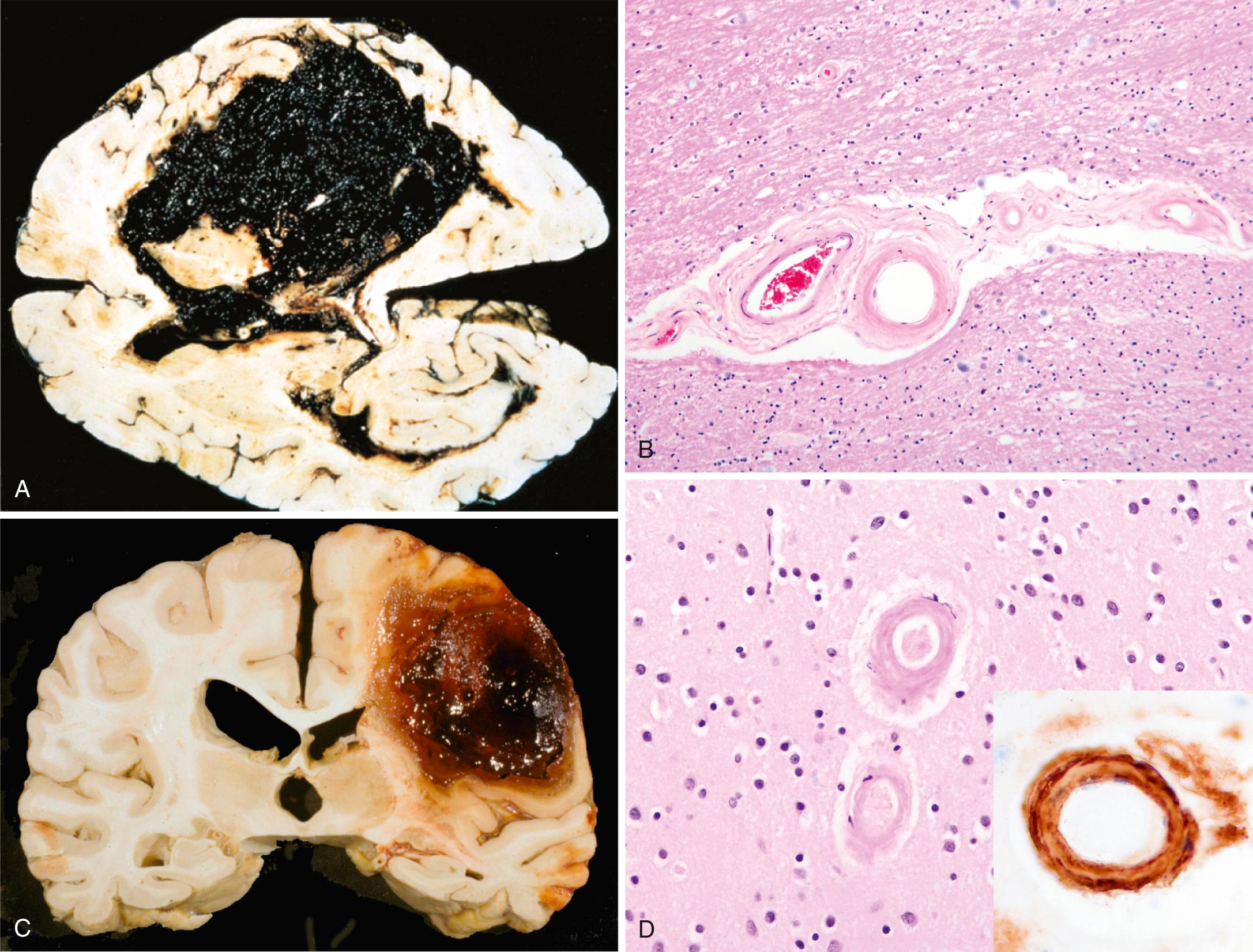 Figure 28.18, (A) Massive hypertensive ganglionic hemorrhage rupturing into a lateral ventricle. (B) Hyaline arteriolosclerosis (fibrosis and thickening of the arteriolar walls) develops in the basal ganglia and subcortical white matter of patients with long-standing hypertension; it is a risk factor for hypertensive hemorrhages as well as lacunar infarcts. (C) Large lobar hemorrhage due to cerebral amyloid angiopathy; it focally dissects into the subarachnoid space. (D) Amyloid deposition in cortical arterioles in cerebral amyloid angiopathy; inset, immunohistochemical staining for Aβ highlights the deposited material in the vessel wall. (C,