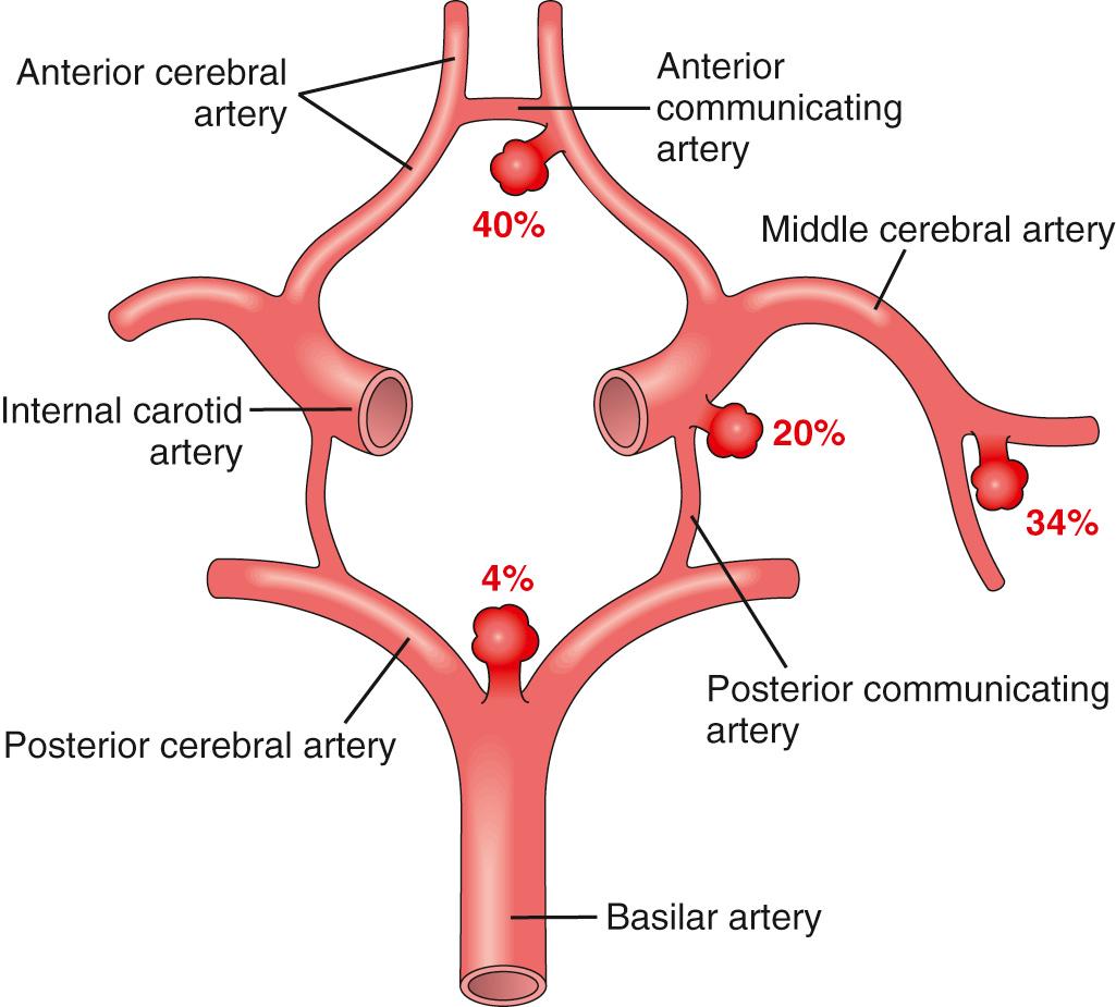 Figure 28.19, Common sites of saccular (berry) aneurysms in the circle of Willis.