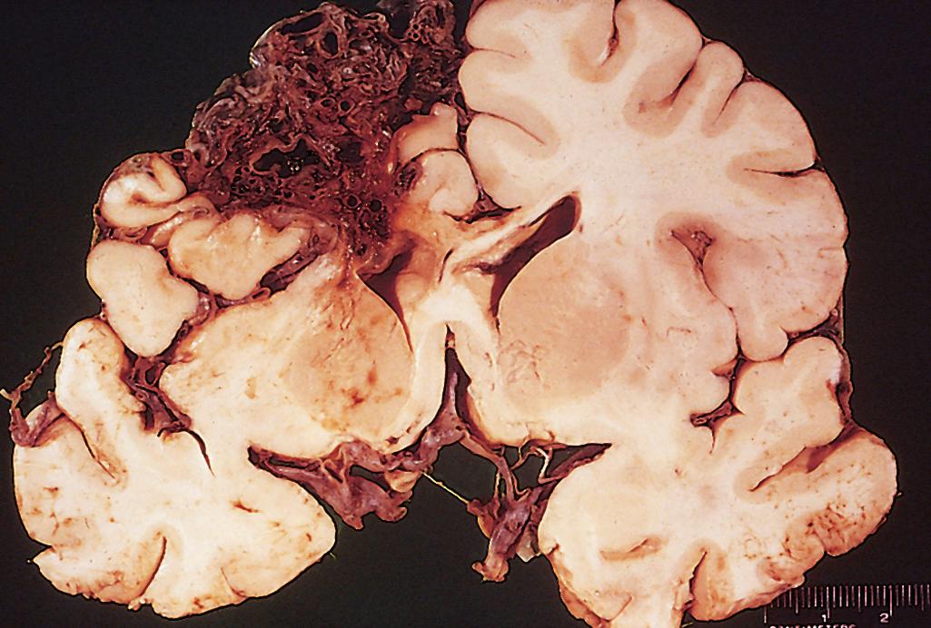 Figure 28.21, Large arteriovenous malformation in the left cerebral hemisphere.