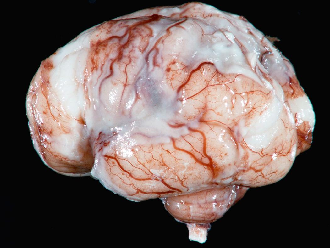 Figure 28.22, Pyogenic meningitis. A thick layer of suppurative exudate covers the brain surface and thickens the leptomeninges.