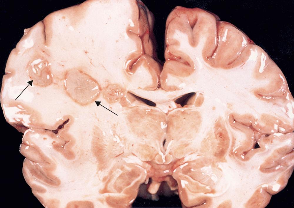 Figure 28.23, Cerebral abscesses (arrows).