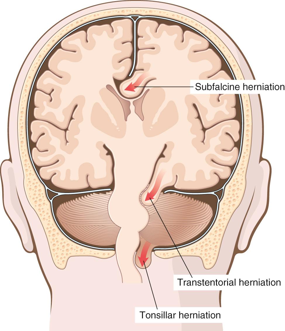 Figure 28.3, Major herniation syndromes of the brain: subfalcine, transtentorial, and tonsillar.