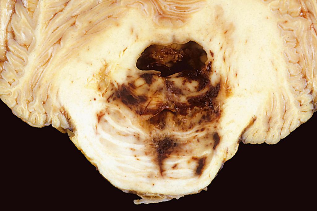 Figure 28.4, Duret hemorrhage. As mass effect displaces the brain downward, there is disruption of the vessels that enter the pons along the midline, leading to hemorrhage.