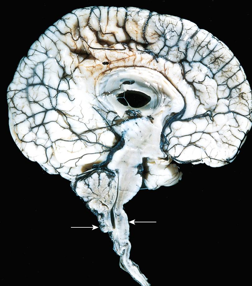 Figure 28.7, Arnold-Chiari malformation. Midsagittal section showing small posterior fossa contents, downward displacement of the cerebellar vermis, and deformity of the medulla ( arrows indicate the approximate level of the foramen magnum).