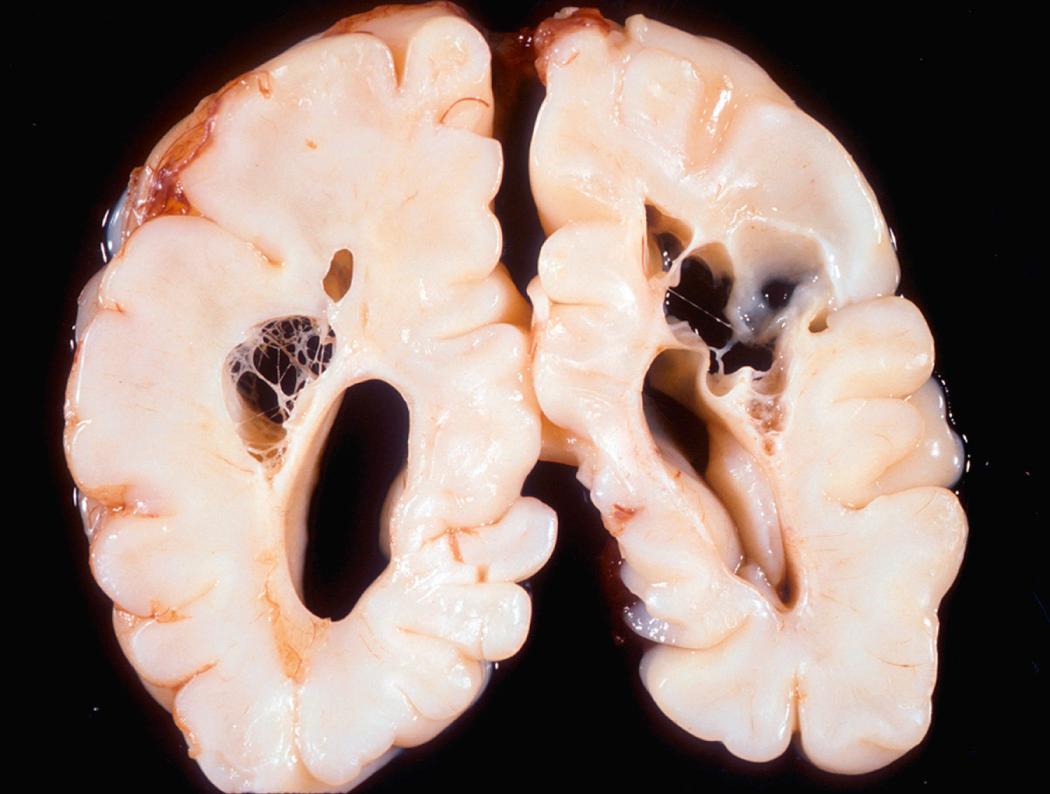 Figure 28.8, Chronic stage of periventricular leukomalacia. Large cystic spaces in the periventricular white matter (seen in both hemispheres of this brain) are the long-term sequalae of a severe prenatal or perinatal ischemic injury.