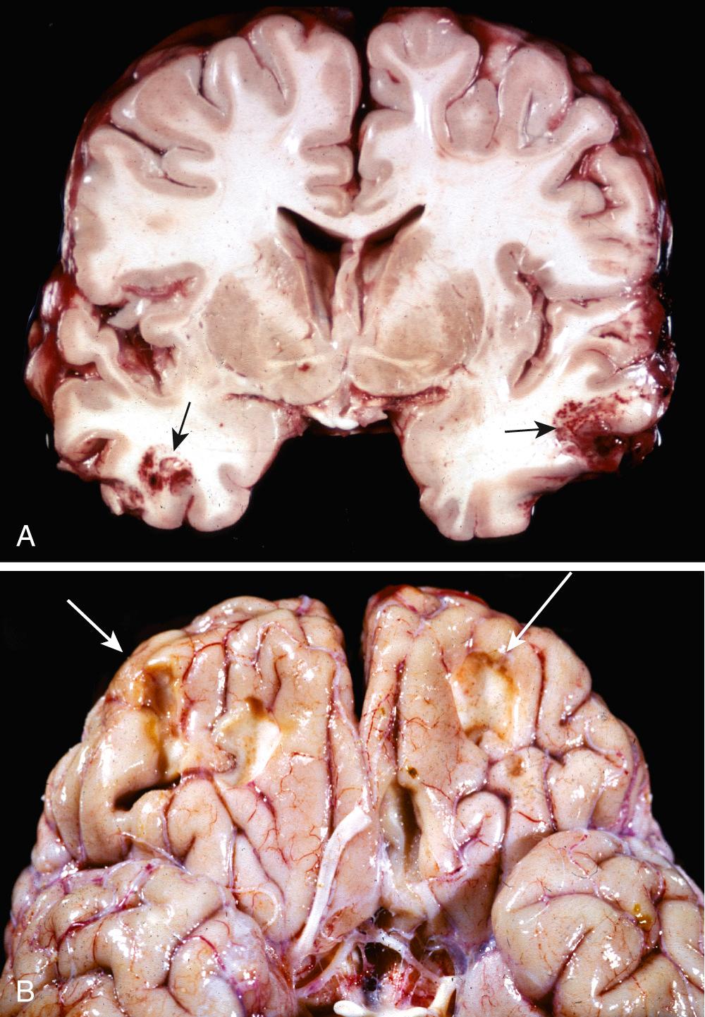 Figure 28.9, (A) Acute contusions are present in both temporal lobes, with areas of hemorrhage and tissue disruption (arrows). (B) Remote contusions (arrows) are present on the inferior frontal surface of this brain and have a yellow color (plaque jaune) that reflects hemosiderin accumulation.