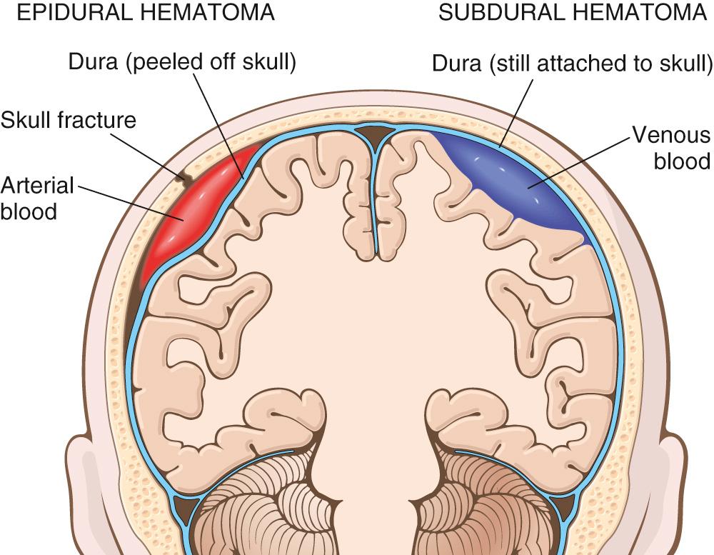 Figure 28.10, Epidural hematoma (left) in which rupture of a meningeal artery, usually associated with a skull fracture, leads to accumulation of arterial blood between the dura and the skull. In a subdural hematoma (right), damage to bridging veins between the brain and the superior sagittal sinus leads to the accumulation of blood between the dura and the arachnoid.