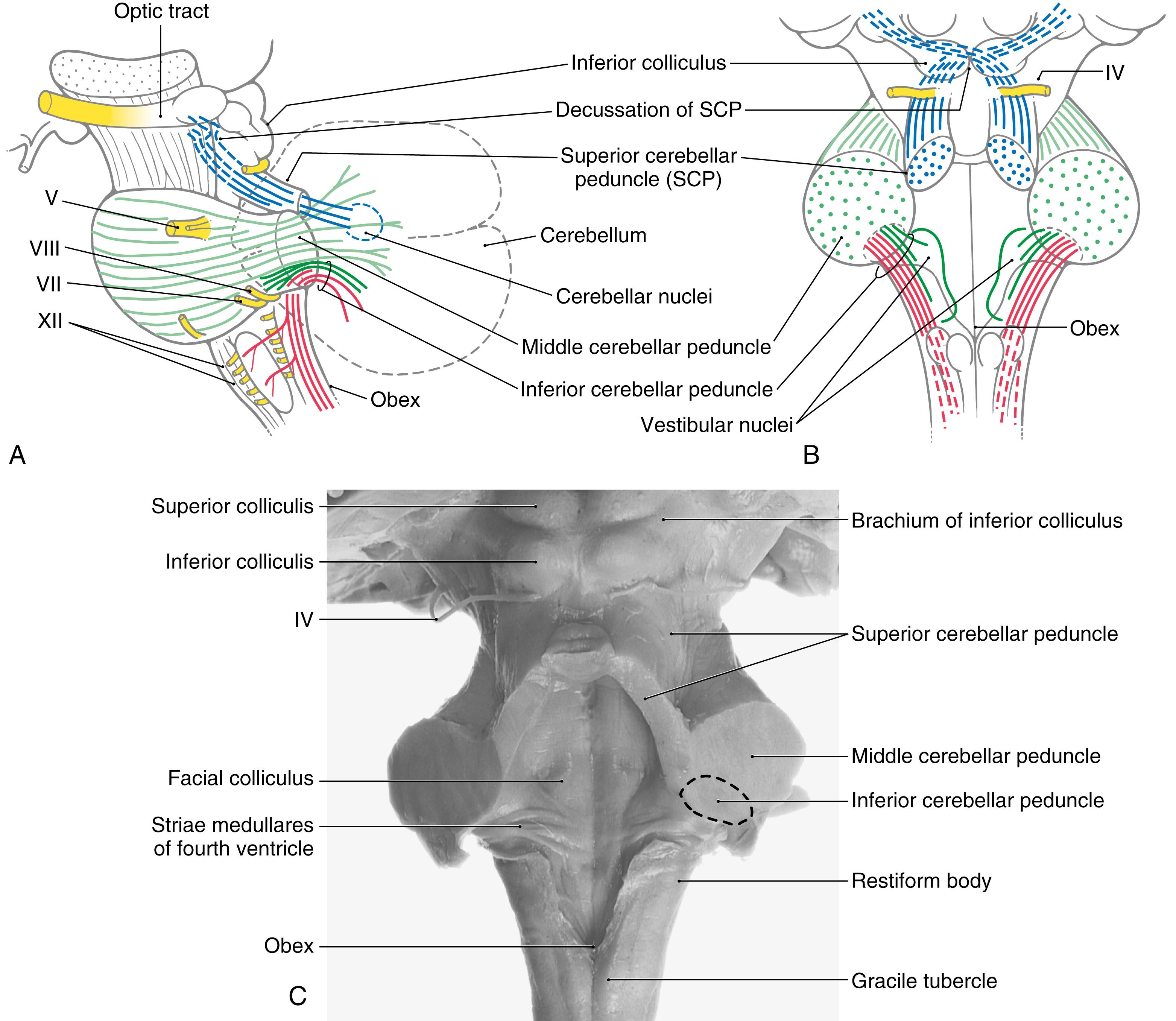 Fig. 27.1, Lateral ( A ) and posterior ( B ) views of the brainstem showing the inferior ( dark green and red ), middle ( light green ), and superior ( blue ) cerebellar peduncles. The inferior peduncle is composed of juxtarestiform ( dark green ) and restiform ( red ) bodies. Superior view ( C ) showing the positions and relationships of the three cerebellar peduncles in a brain specimen. Cranial nerves are identified by Roman numerals. The cranial nerves are highlighted.