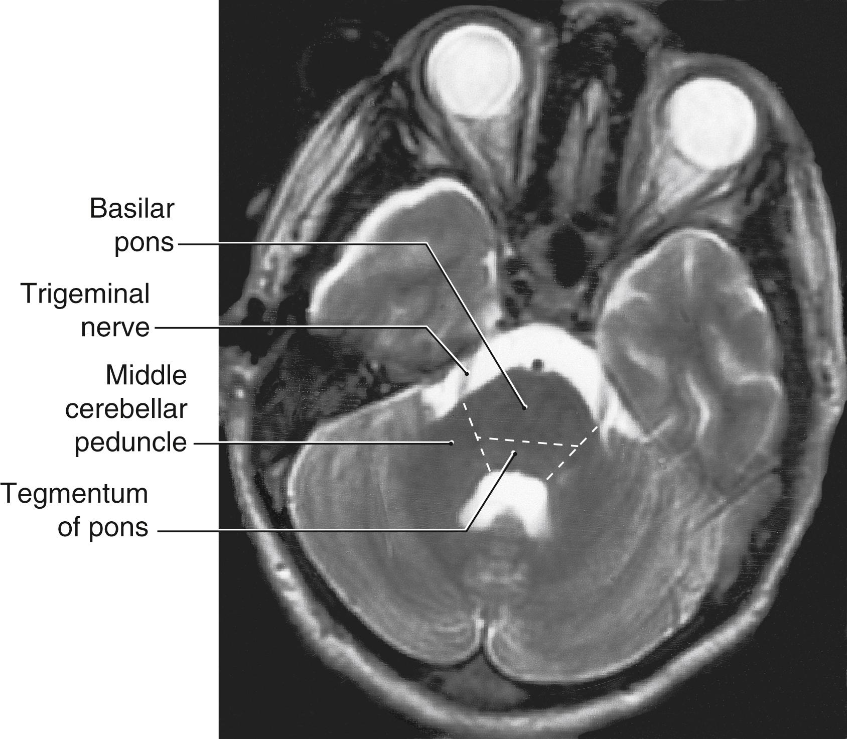 Fig. 27.2, Axial magnetic resonance image of the cerebellum and pons showing the relationship between the root of the trigeminal nerve and the basilar pons (inferior to the root) and the middle cerebellar peduncle (superior to the root). Compare with Fig. 27.1 .