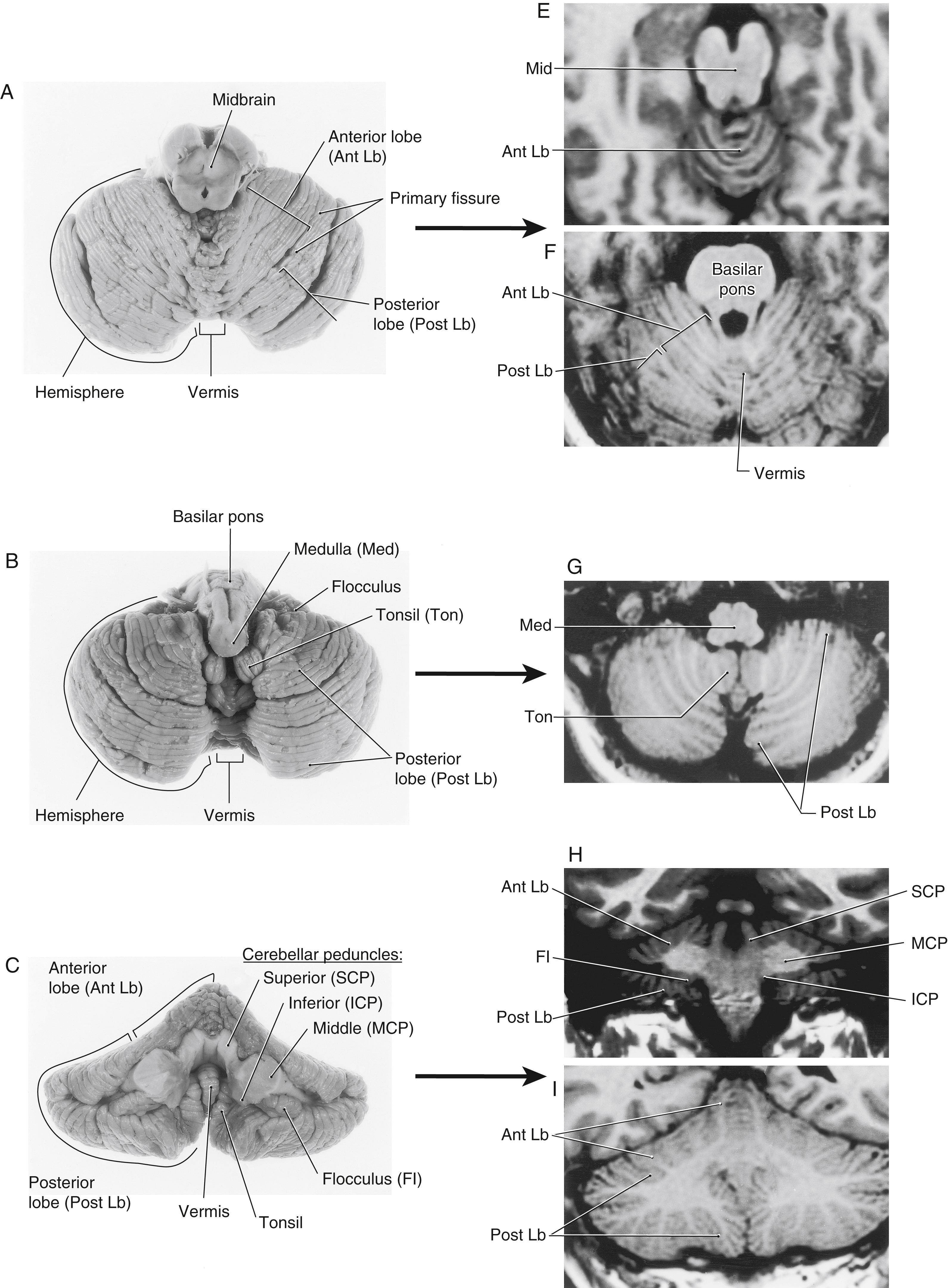 Fig. 27.4, Rostral ( A, superior aspect), caudal ( B, inferior aspect), anterior or ventral ( C, with brainstem removed), and medial sagittal ( D ) views of the cerebellum compared with corresponding views of the cerebellum in magnetic resonance imaging ( E to J ). In rostral views ( A and E, J ), the folia of the anterior lobe can characteristically be followed across the midline. The tonsil and its close relationship with the medulla are seen in inferior views ( B and G, H ); the peduncles and the lobes are clearly evident in anterior (ventral) views ( C and H, I ).The medial sagittal views ( D and J ) reveal the relationship of the cerebellum to the fourth ventricle and brainstem.