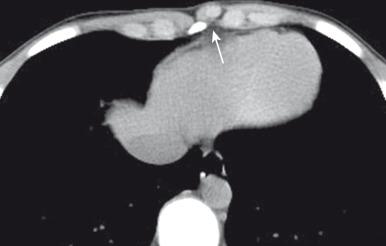 Figure 59.1, Chondral nodule in an adolescent boy who presented with a focal, palpable, painless lump in the anterior chest wall.