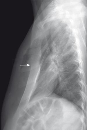 Figure 59.2, Pectus excavatum in an 8-year-old girl.