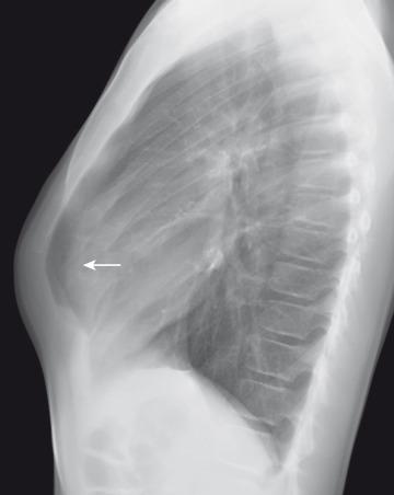 Figure 59.3, Pectus carinatum in an adolescent boy.