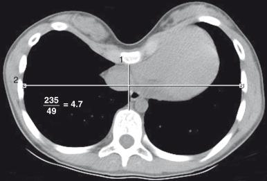 Figure 59.4, Pectus index.