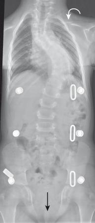 e-Figure 59.5, Cleidocranial dysostosis in an adolescent boy.