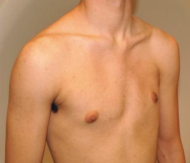 e-Figure 59.6, Poland syndrome in an adolescent boy.