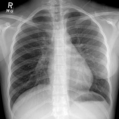 Figure 59.7, Poland syndrome in an adolescent girl.