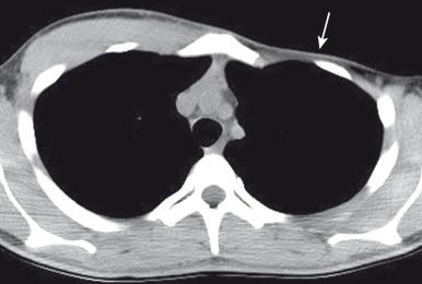 Figure 59.8, Poland syndrome in an adolescent boy.