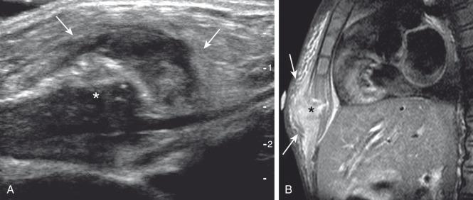 Figure 59.9, Sternal osteomyelitis in a 6-year-old girl who presented with prolonged fever and a painful, palpable, and erythematous sternal lump.