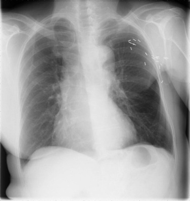 Fig. 3.1, Left Mastectomy.