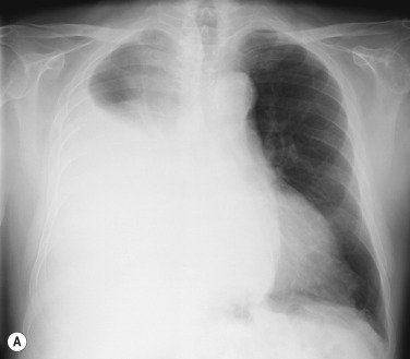 Fig. 3.11, Massive Pleural Effusion With Mediastinal Shift to the Left.