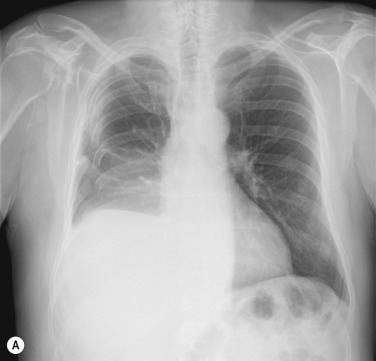 Fig. 3.12, Subpulmonary Pleural Effusion.