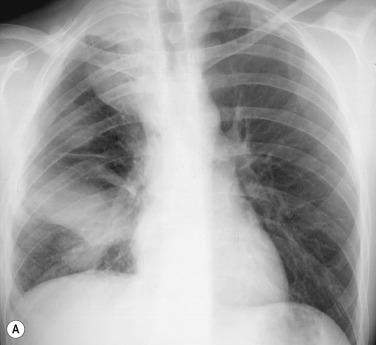 Fig. 3.13, Encapsulated Fluid on (A) Posteroanterior and (B) Lateral Chest Radiographs.