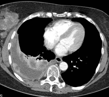 Fig. 3.15, Computed Tomography of Malignant Pleural Disease.