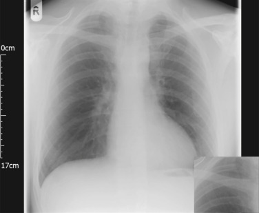 Fig. 3.3, Inferior Rib Notching.