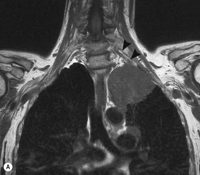 Fig. 3.4, Pancoast Tumour.