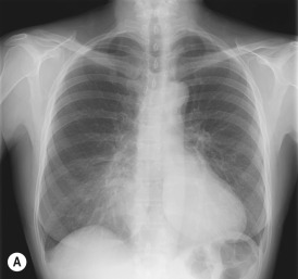 Fig. 3.5, Depressed Sternum.