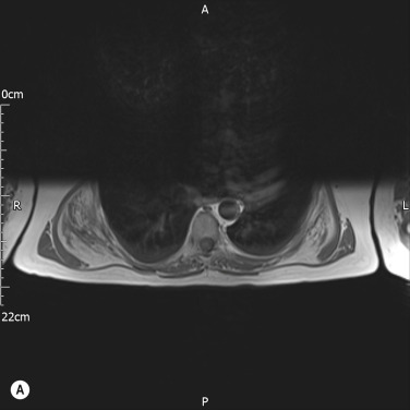 Fig. 3.6, Elastofibroma Dorsi.