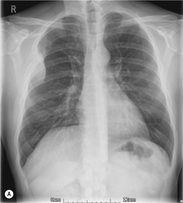 Fig. 3.9, Fibrous Dysplasia in a Rib.