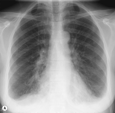 Fig. 3.10, Bilateral Pleural Effusion.