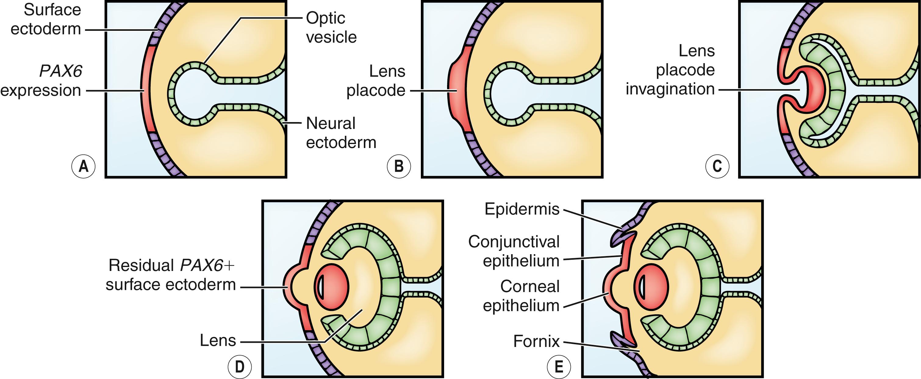 Fig. 2.1, Conjunctival embryogenesis. Apposition of the optic vesicle to overlying surface ectoderm results in localized PAX6 expression ( A ) and induction of the lens placode ( B ). After invagination of the lens placode ( C ), residual PAX6 + surface ectoderm ( D ) differentiates into conjunctival, limbal, and corneal epithelium ( E ).