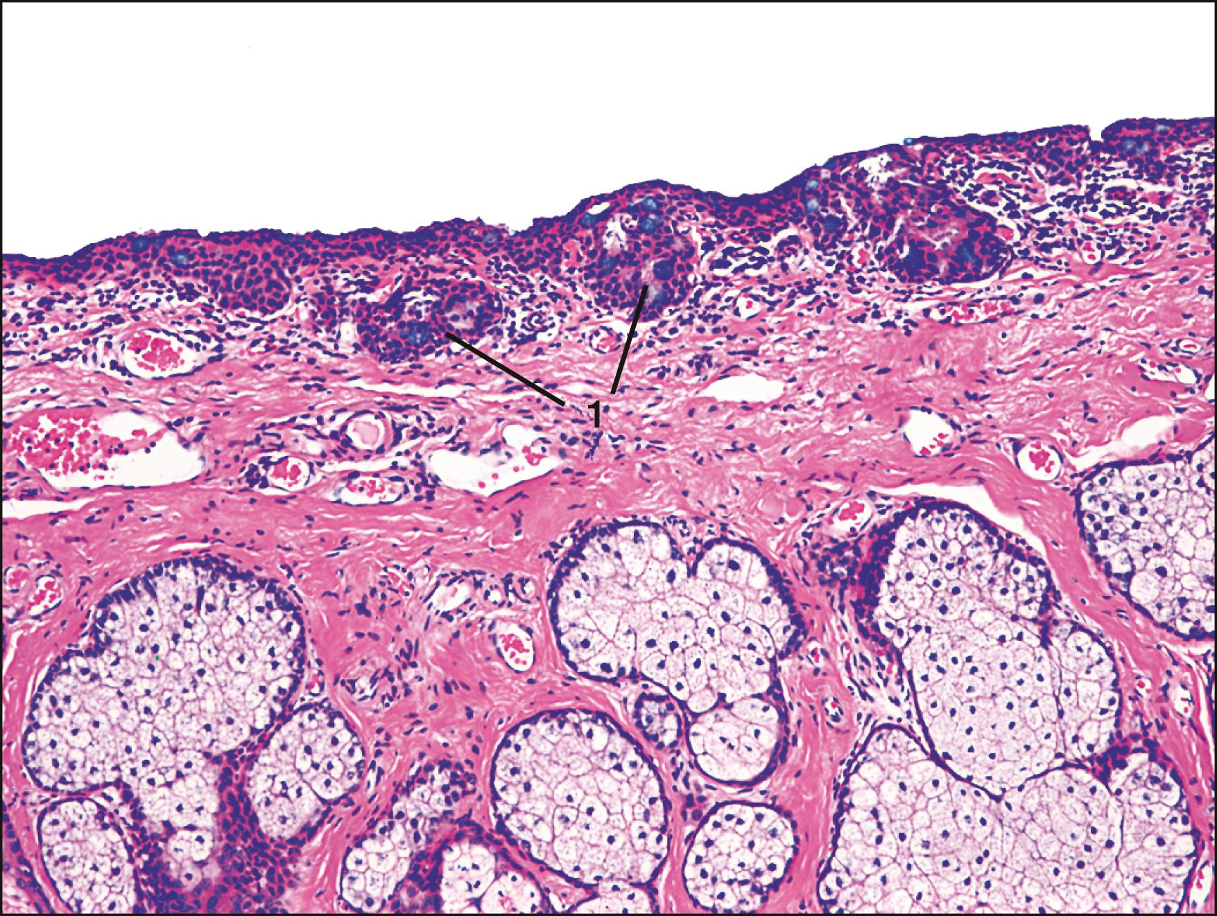 Fig. 2.3, Histologic section of tarsal conjunctiva showing the pseudocrypts of Henle (1) .