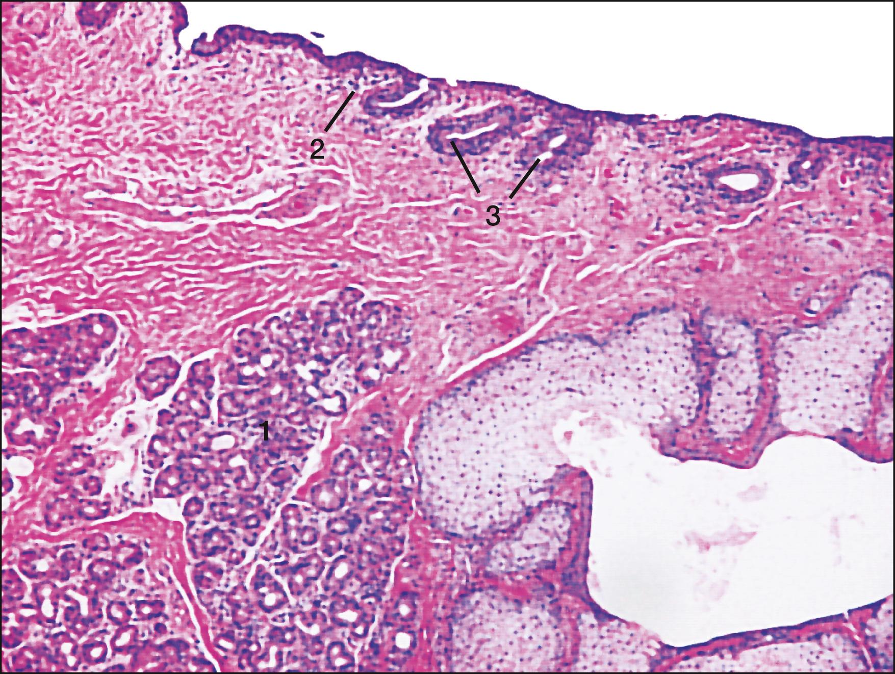 Fig. 2.4, Histologic section through the superior tarsus demonstrating the glands of Wolfring (1) , lymphocytes in the adenoid layer (2) , and pseudocrypts of Henle (3) .