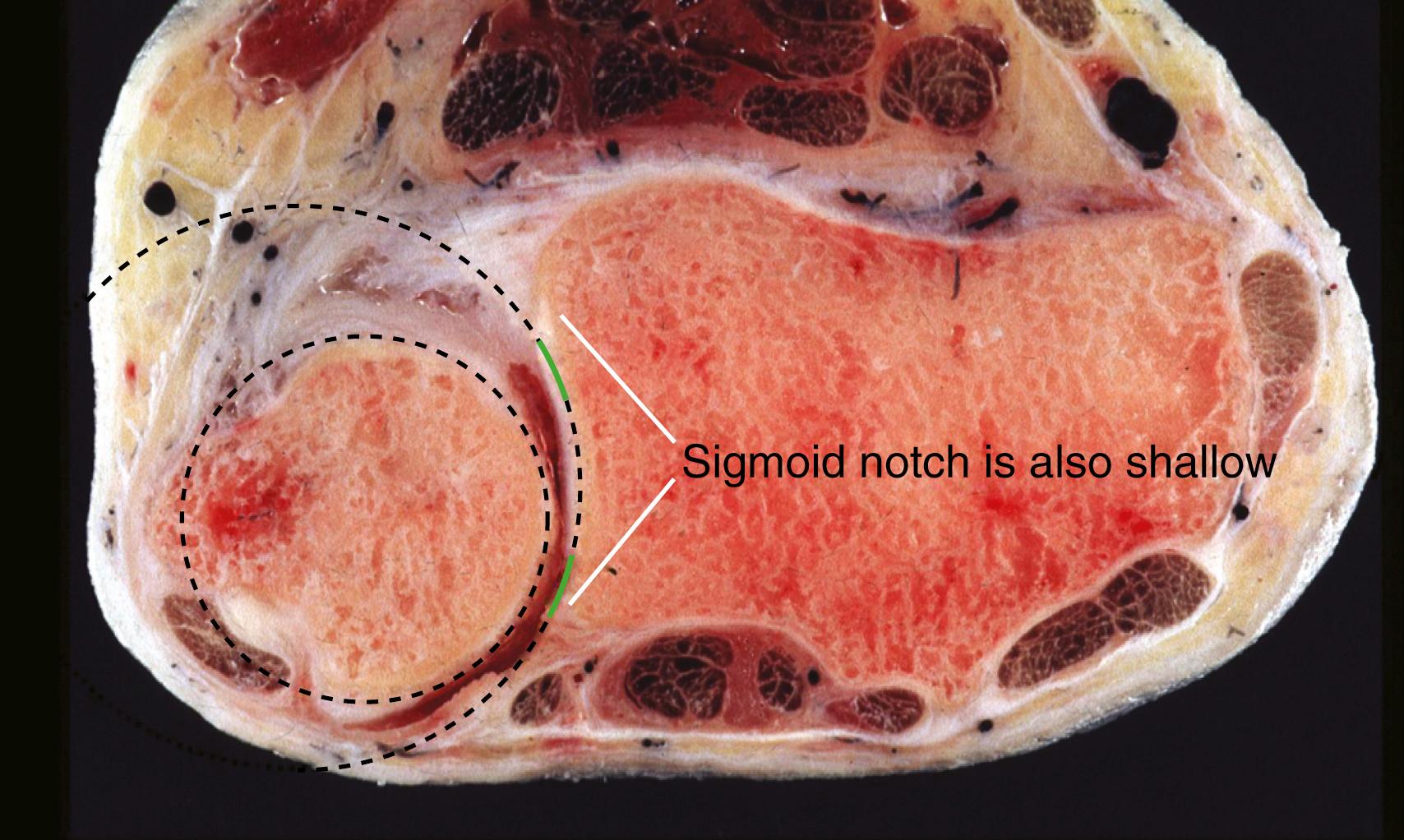 Fig. 14.2, Cross section through distal radial ulnar joint in a cadaver. The rims of the sigmoid notch are augmented by fibrocartilaginous lips. The sigmoid notch is shallow, and its radius at curvature is substantially larger than at the ulnar head.