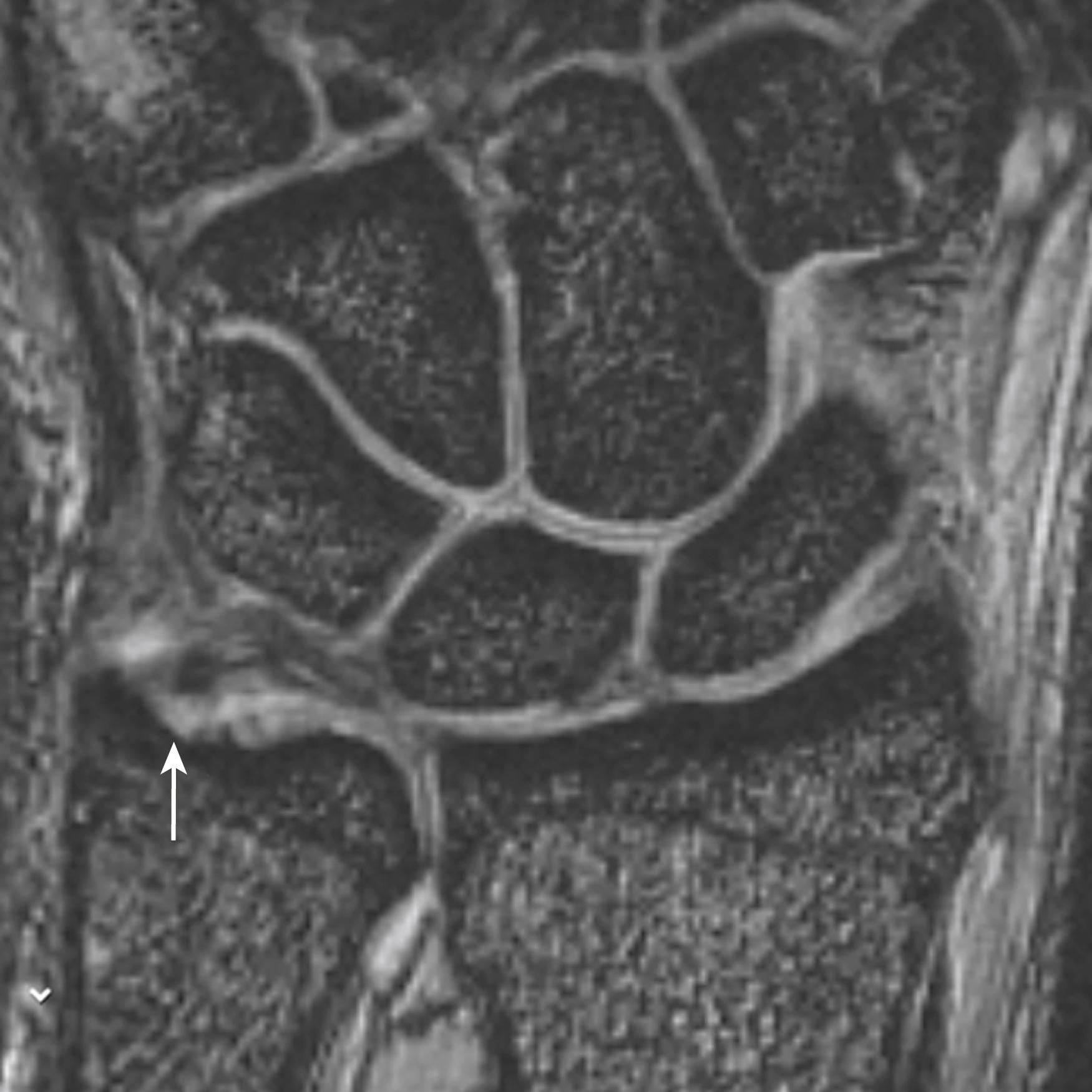 Fig. 14.12, Coronal 3D magnetic resonance image of ulnar-peripheral tear of triangular fibrocartilage complex, with avulsion from the fovea.